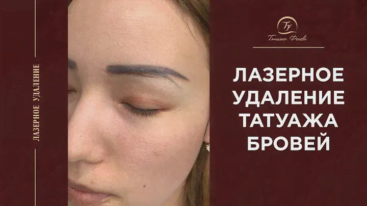 Лазерное удаление перманентного макияжа бровей