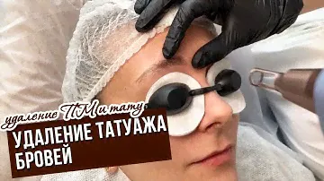 Лазерное удаление перманентного макияжа бровей