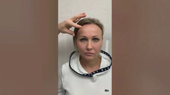 Блефаропластика и эндоскопическая подтяжка лба